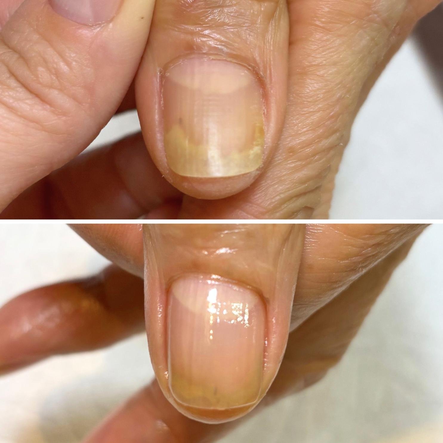 手の剥離の症例